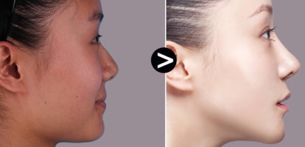 自体软骨隆鼻后遗症