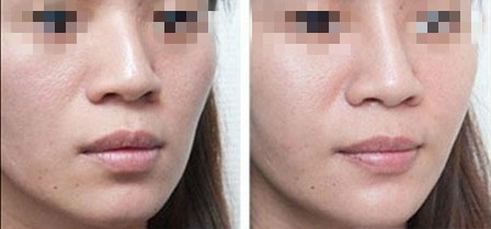 膨体隆鼻后期效果