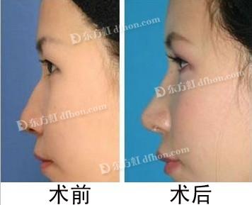 国产膨体隆鼻多少钱