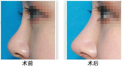 膨体隆鼻恢复时间