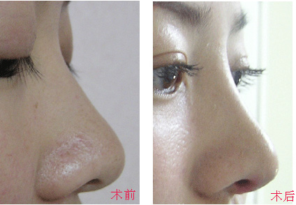 膨体隆鼻感染的症状