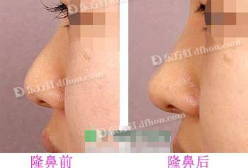 玻尿酸隆鼻维持时间