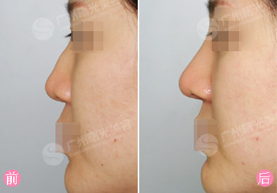 玻尿酸隆鼻效果图