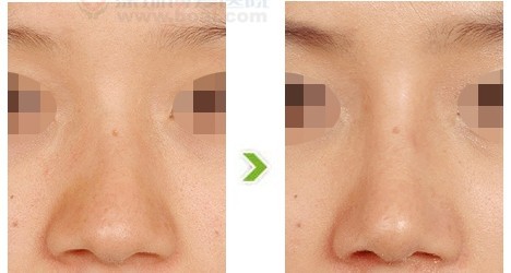 注射隆鼻能维持多久