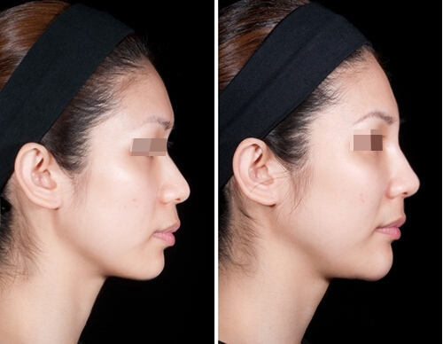 假体隆鼻手术多少钱