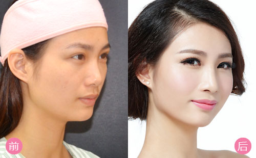 硅胶隆鼻前后对比