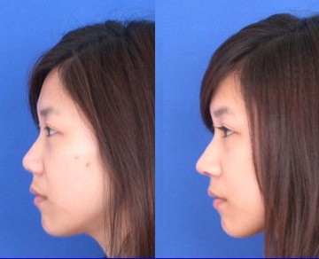 假体隆鼻安全吗