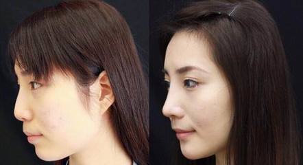 做硅胶隆鼻多少钱   