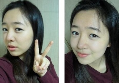 自体脂肪隆鼻价格