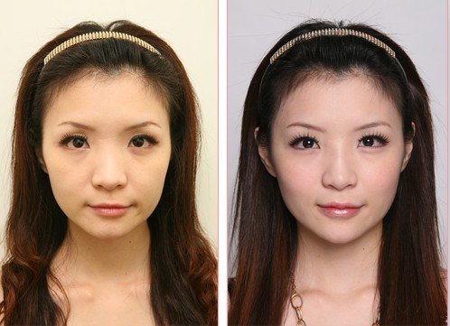 自体脂肪隆鼻价钱