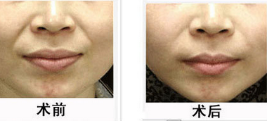 鼻唇沟微整形   