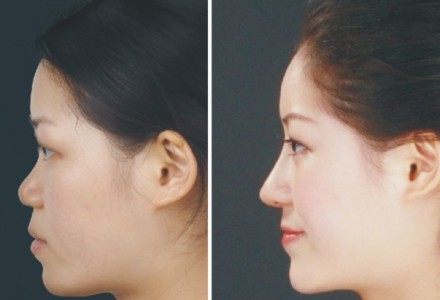 硅胶隆鼻大概多少钱