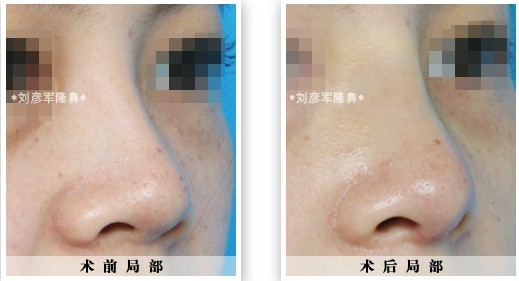 硅胶隆鼻的副作用