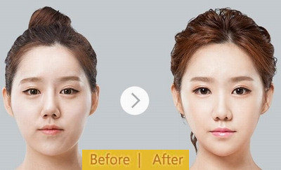 硅胶隆鼻假体取出