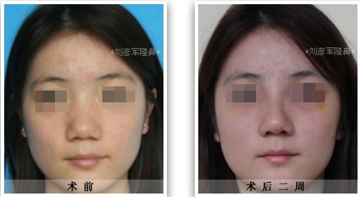 硅胶隆鼻整形手术