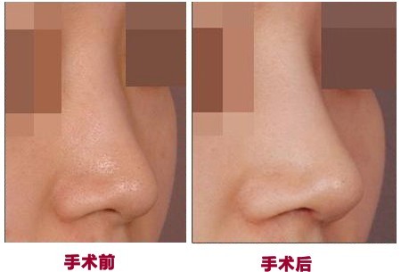 硅胶隆鼻多少钱