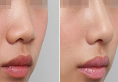 硅胶隆鼻要多少钱