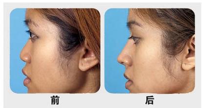 玻尿酸隆鼻价格是多少