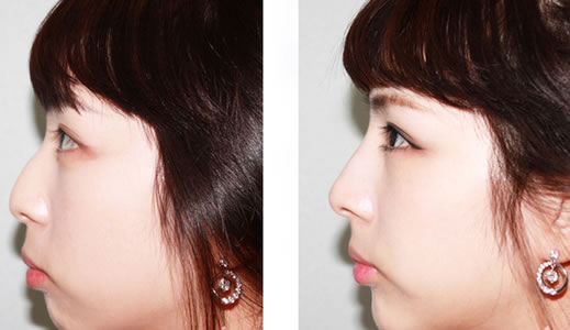 注射隆鼻要多少钱