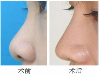 硅胶隆鼻效果好吗