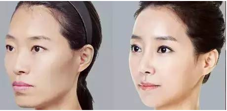 自体脂肪隆鼻价钱一般是多少?