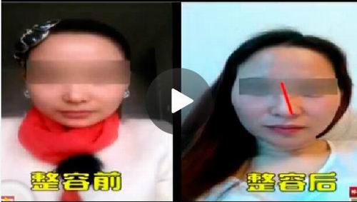偏要去美容店隆鼻 结果她的鼻子被整歪了