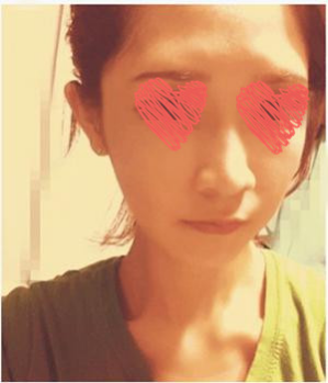 自体脂肪填充+隆鼻 变元气少女脸就是我！