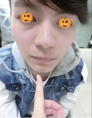 硬汉也爱美：玻尿酸调整歪下巴+隆鼻