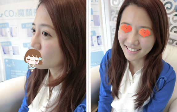 打玻尿酸后 我的苹果肌+翘鼻子粉嫩登场！