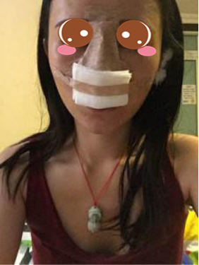 做完膨体隆鼻 本宝来晒术后恢复图咯！
