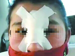 民宅内做注射隆鼻 女子鼻子毁了