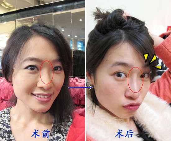 乔雅登玻尿酸隆鼻前后对比图