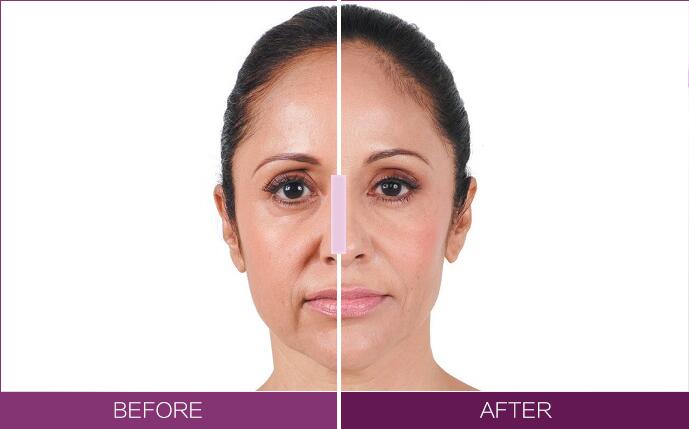 乔雅登玻尿酸填充鼻唇沟效果对比图