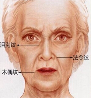 我们的脸上会有哪些“沟”?