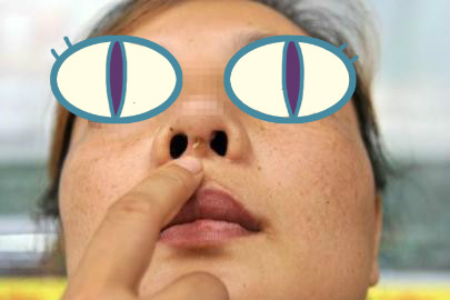 假体隆鼻出现穿孔