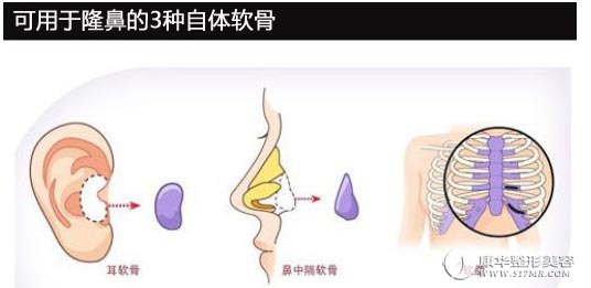 自体软骨隆鼻