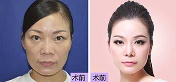 隆鼻？上千元与上万元的差距在哪里