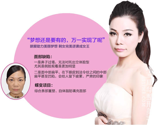 自体脂肪填充+综合鼻部重塑 沧桑大妈变身美少女