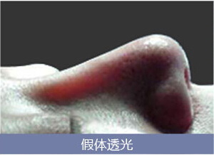 隆鼻后鼻梁会透光