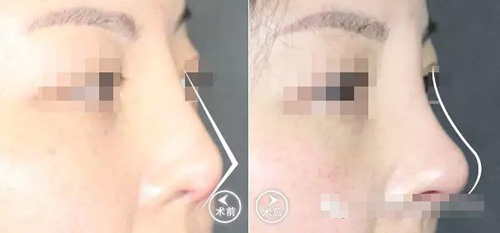 3次隆鼻失败 博仕重塑自信美鼻