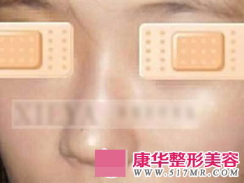 做了鼻部整形手术 帮我看看变化大不大