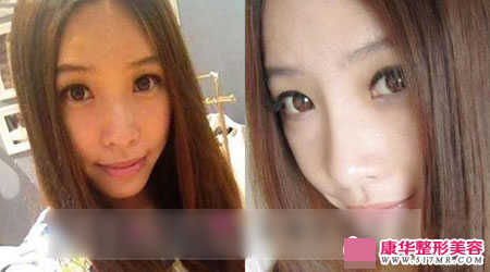 玻尿酸注射隆鼻案例分享 见证鼻子的蜕变历程