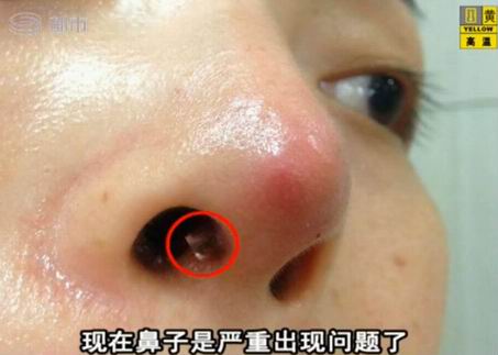隆鼻假体*出鼻尖