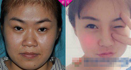 真人隆鼻手术真人秀 塌鼻女子大变身