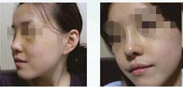 隆鼻手术整形前后