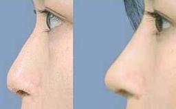 隆鼻前后的效果对比图