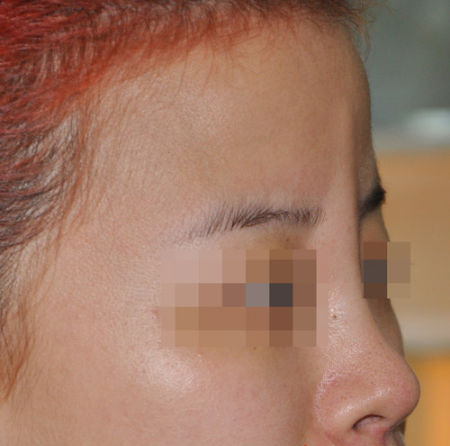 “玻尿酸”隆鼻后的颜小姐