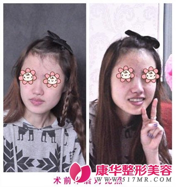 “无鼻”女变“有鼻”激动得落泪！