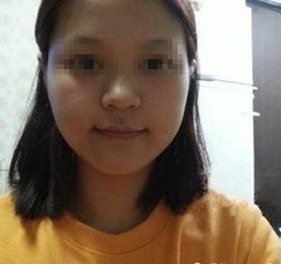 小敏隆鼻手术前的样子