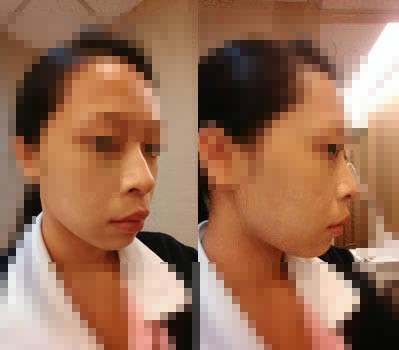 隆鼻垫下巴前的样子